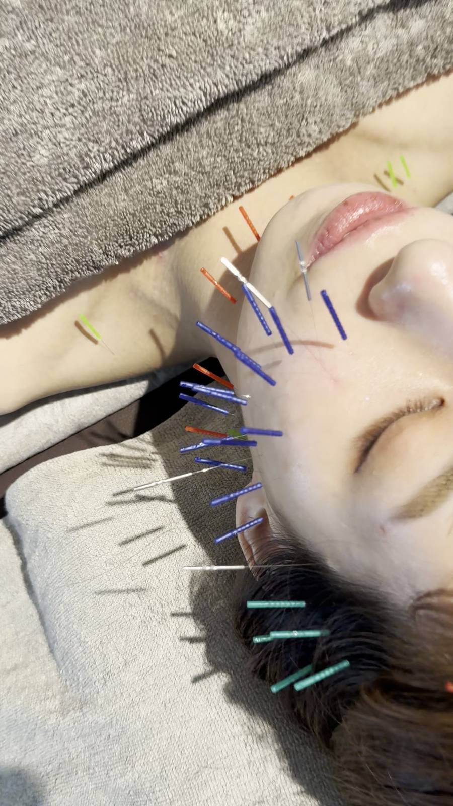 美容鍼の施術